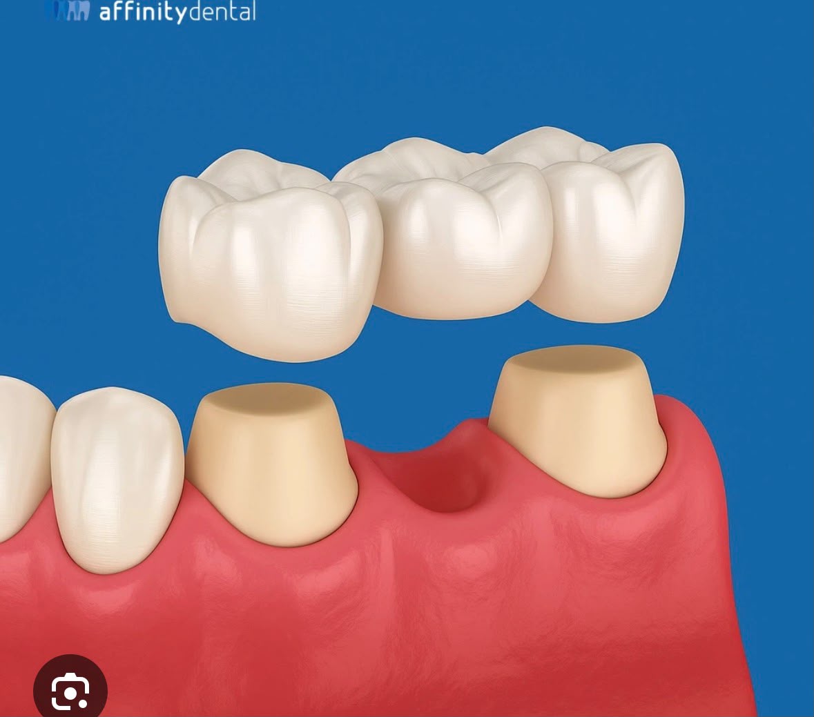 Model i kurorave dentare prej zirkoni